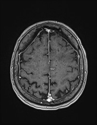 Cerebral amyloid angiopathy-related inflammation (Radiopaedia 58270-65377 Axial T1 C+ fat sat 113).jpg