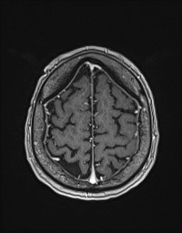 Cerebral amyloid angiopathy-related inflammation (Radiopaedia 58270-65377 Axial T1 C+ fat sat 125).jpg