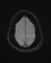Cerebral amyloid angiopathy-related inflammation (Radiopaedia 74836-85849 Axial SWI 63).jpg