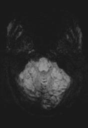 File:Cerebral amyloid angiopathy (Radiopaedia 29129-29518 Axial SWI MIP 6).jpg