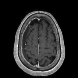 Cerebral amyloid angiopathy (Radiopaedia 29129-29518 Axial T1 C+ 122).jpg