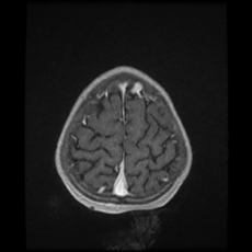 Cerebral and spinal tuberculosis (Radiopaedia 90489-107837 Axial T1 C+ 169).jpg
