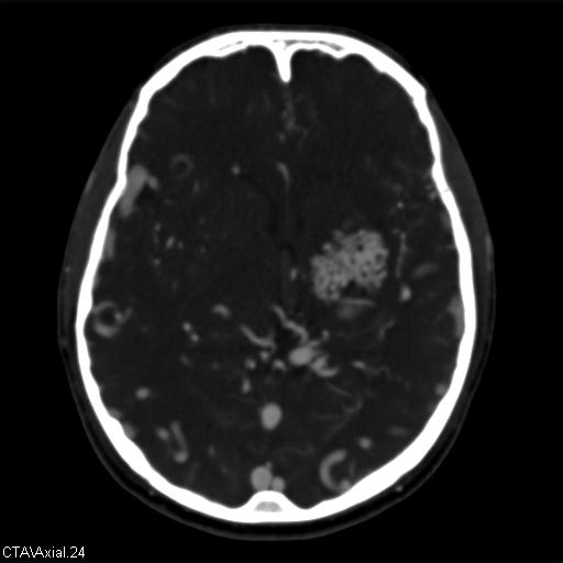 Cerebral arteriovenous malformation (Radiopaedia 28518-28759 B 24).jpg