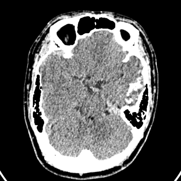 Cerebral arteriovenous malformation (Radiopaedia 37182-39012 Axial non-contrast 16).jpg