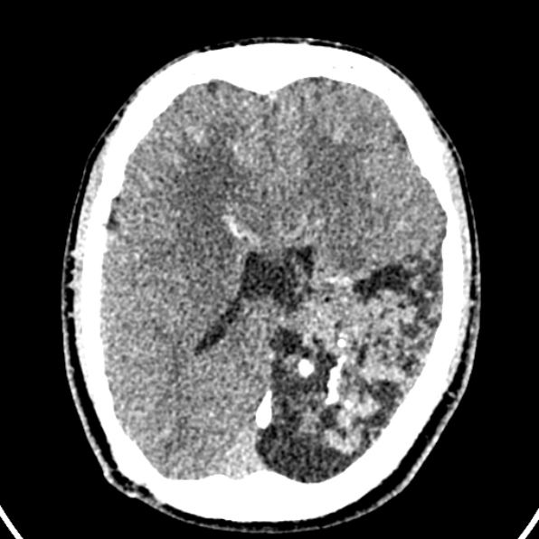 Cerebral arteriovenous malformation (Radiopaedia 37182-39012 Axial non-contrast 30).jpg