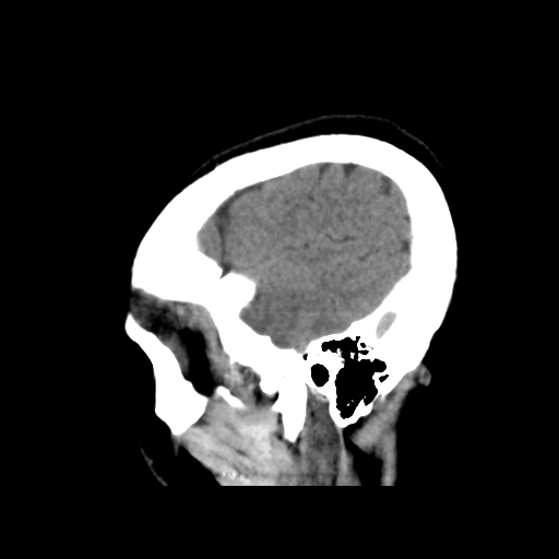 File:Cerebral arteriovenous malformation (Radiopaedia 39259-41505 B 30).png