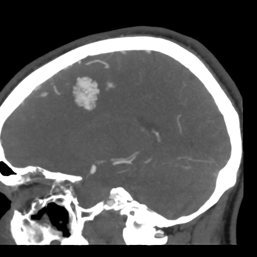 File:Cerebral arteriovenous malformation (Radiopaedia 39259-41505 Sagittal 24).png