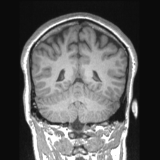 Cerebral arteriovenous malformation (Radiopaedia 39259-41506 Coronal T1 31).png