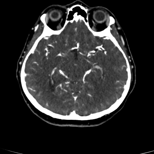Cerebral arteriovenous malformation (Radiopaedia 73830-84645 Axial C+ delayed 53).jpg