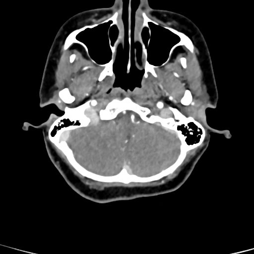 Cerebral arteriovenous malformation (Radiopaedia 73830-84645 B 85).jpg