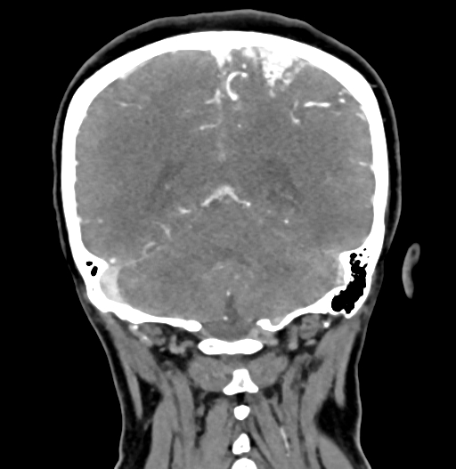 Cerebral arteriovenous malformation (Radiopaedia 73830-84645 C 70).jpg