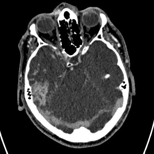 Cerebral arteriovenous malformation (Radiopaedia 78188-90746 Axial C+ delayed 57).jpg