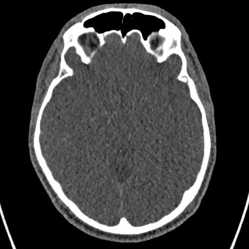 File:Cerebral arteriovenous malformation (Radiopaedia 78188-90746 Axial non-contrast 75).jpg