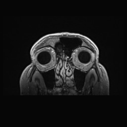Cerebral arteriovenous malformation (Radiopaedia 84015-99245 Coronal T1 C+ 19).jpg