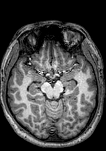 Cerebral arteriovenous malformation at posterior body of corpus callosum (Radiopaedia 74111-84925 Axial T1 187).jpg