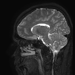 Cerebral arteriovenous malformation at posterior body of corpus callosum (Radiopaedia 74111-84925 Sagittal T2 53).jpg