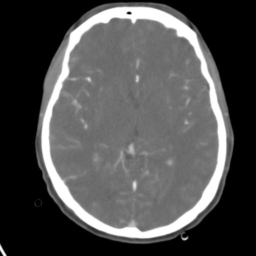 Cerebral arteriovenous malformation with hemorrhage (Radiopaedia 28773-29073 A 29).jpg
