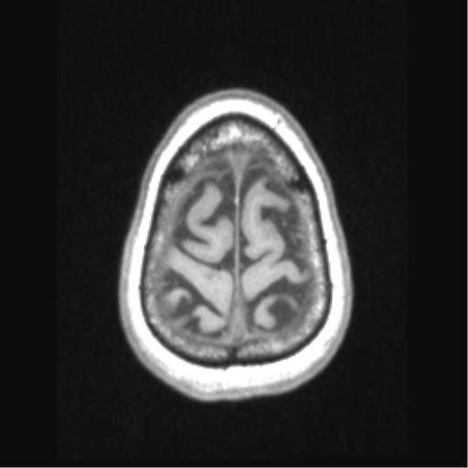 Cerebral arteriovenous malformation with hemorrhage (Radiopaedia 34422-35737 Axial T1 69).png