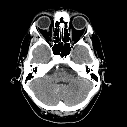 Cerebral arteriovenous malformation with lobar hemorrhage (Radiopaedia 35598-57216 A 14).jpg