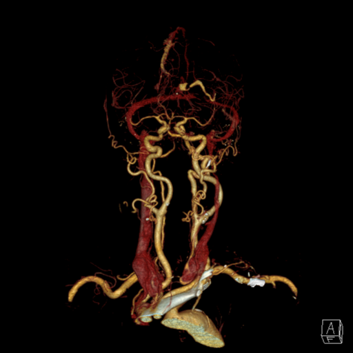File:Cerebral arteriovenous malformation with lobar hemorrhage (Radiopaedia 44725-48512 3D VRT 3).png