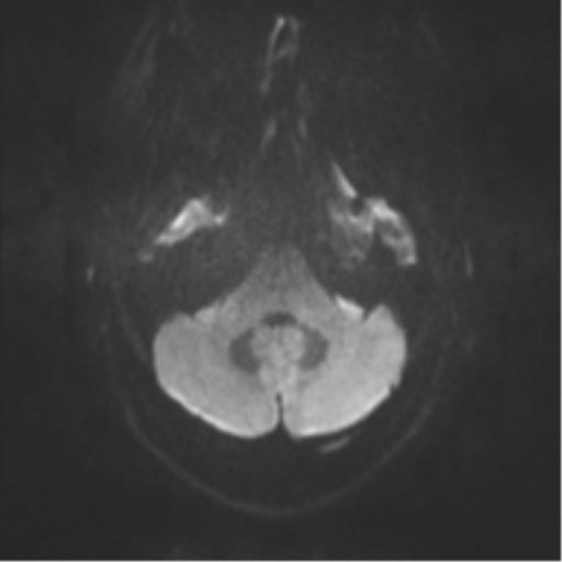 File:Cerebral cavernoma and development venous anomaly (Radiopaedia 37603-39482 Axial DWI 29).png