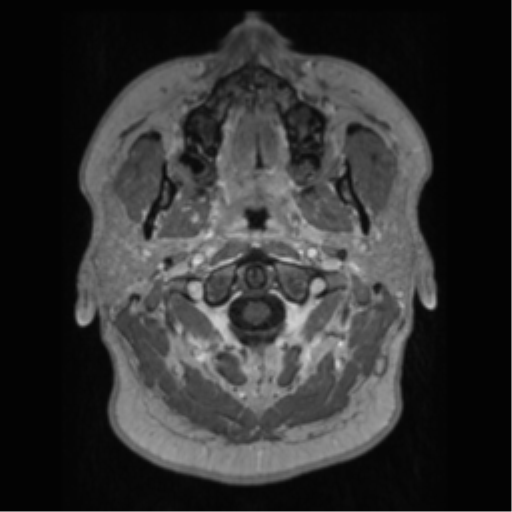 File:Cerebral cavernoma and development venous anomaly (Radiopaedia 37603-39482 Axial T1 C+ 1).png