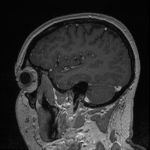 Cerebral cavernoma and development venous anomaly (Radiopaedia 37603-39482 Sagittal T1 C+ 72).png