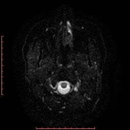 File:Cerebral cavernous malformation (Radiopaedia 26177-26306 Axial DWI 22).jpg