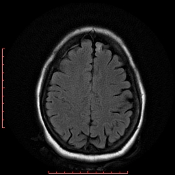 File:Cerebral cavernous malformation (Radiopaedia 26177-26306 FLAIR 16).jpg