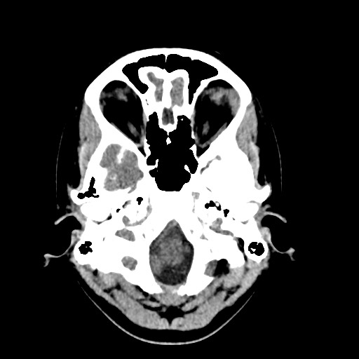 File:Cerebral cavernous venous malformation (Radiopaedia 70008-80022 Axial non-contrast 5).jpg