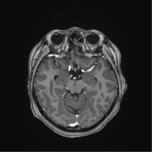 File:Cerebral cavernous venous malformations (Radiopaedia 48117-52946 Axial T1 C+ 20).png