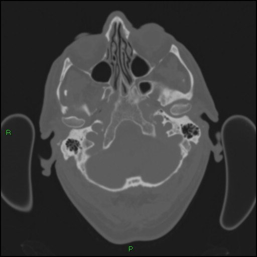 Cerebral contusions (Radiopaedia 33868-35039 Axial bone window 26).jpg