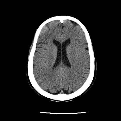 File:Cerebral edema (evolution in time) (Radiopaedia 19418-19441 non-contrast 62).jpg