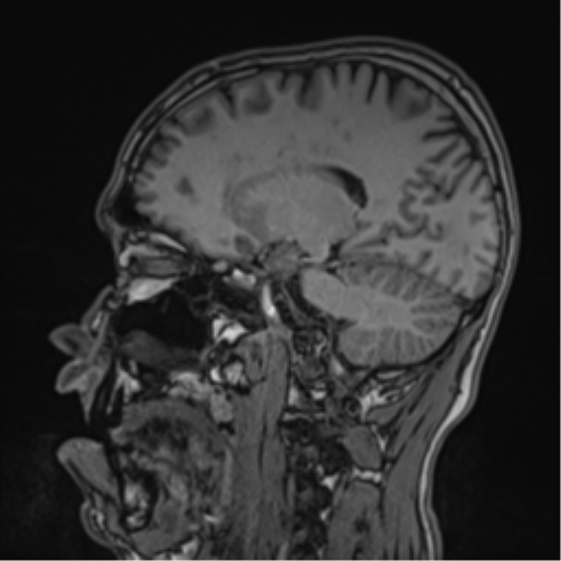 Cerebral fat embolism (Radiopaedia 57697-64639 Sagittal T1 23).png