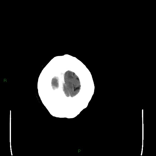 File:Cerebral metastases - breast primary (Radiopaedia 77653-89857 Axial C+ delayed 111).jpg