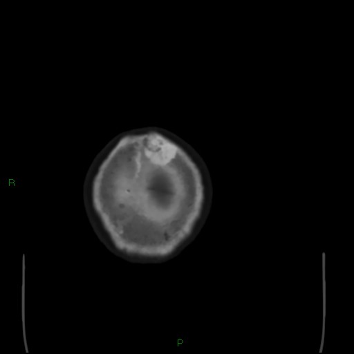 Cerebral metastases - breast primary (Radiopaedia 77653-89857 Axial bone window 114).jpg