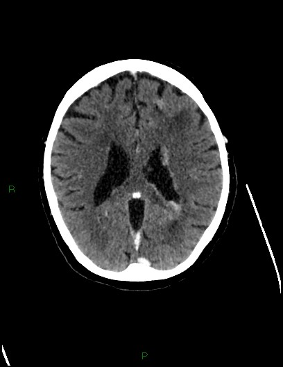 Cerebral metastases - ependymal and parenchymal (Radiopaedia 79877-93131 Axial C+ delayed 52).jpg
