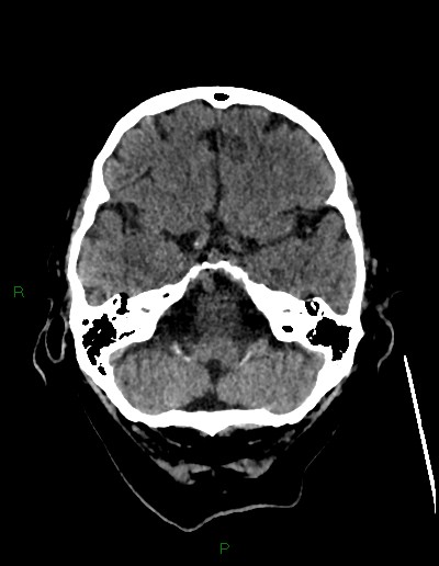 Cerebral metastases - ependymal and parenchymal (Radiopaedia 79877-93131 Axial non-contrast 15).jpg