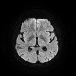 Cerebral metastases - melanoma (Radiopaedia 80972-94522 Axial DWI 48).jpg