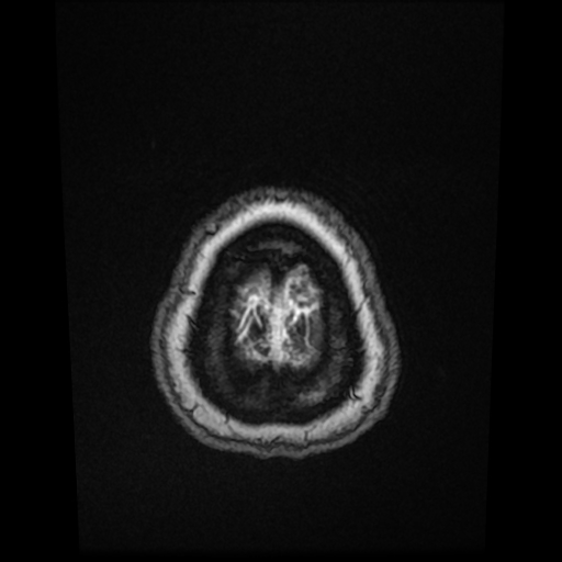 Cerebral metastases - melanoma (Radiopaedia 80972-94522 Axial T1 C+ 87).jpg