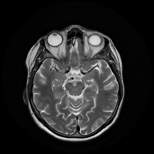 File:Cerebral metastases - melanoma (Radiopaedia 80972-94522 Axial T2 13).jpg