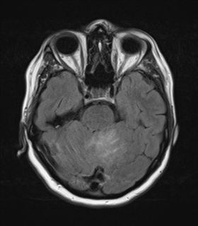 File:Cerebral metastases mimicking abscesses (Radiopaedia 45841-50131 Axial FLAIR 10).png