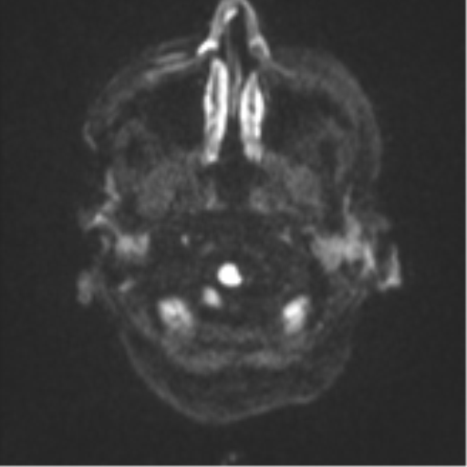 Cerebral metastasis (Radiopaedia 46744-51248 Axial DWI 30).png
