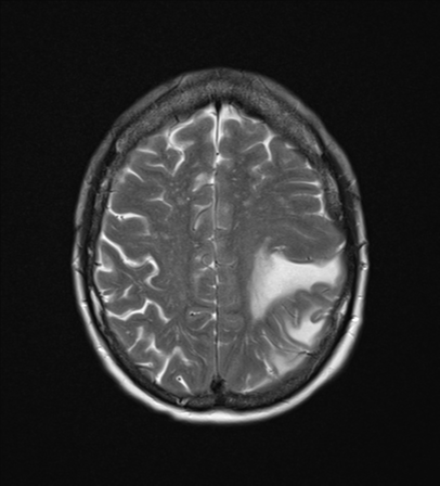 File:Cerebral metastasis (Radiopaedia 46744-51248 Axial T2 21).png