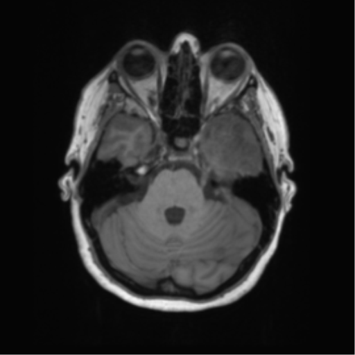 Cerebral metastasis mimicking glioblastoma (Radiopaedia 69155-78937 Axial T1 15).png