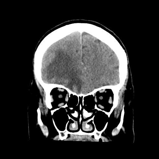 Cerebral metastasis to basal ganglia (Radiopaedia 81568-95412 Coronal C+ delayed 17).png