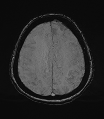 Cerebral metastasis to basal ganglia (Radiopaedia 81568-95413 Axial SWI 65).png