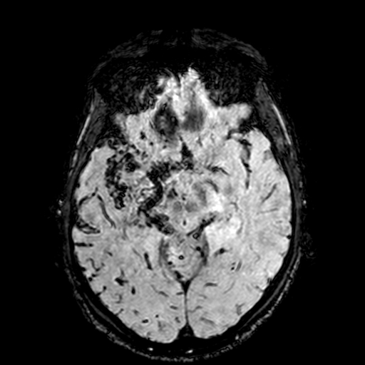 Cerebral parenchymal arteriovenous malformation (Radiopaedia 27280-27456 Axial SWI 45).jpg