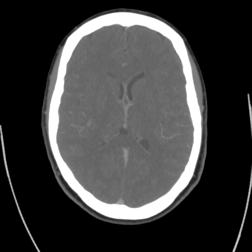 Cerebral venous infarct related to dural venous sinus thromboses (Radiopaedia 35292-36804 Axial C+ delayed 28).png