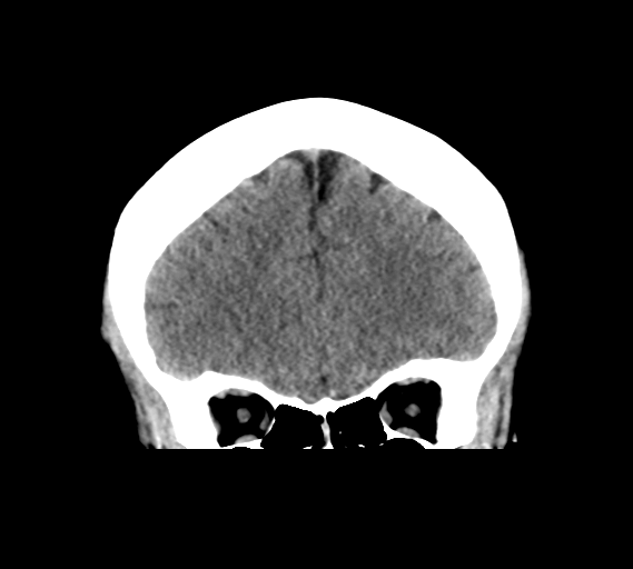 File:Cerebral venous infarct related to dural venous sinus thromboses (Radiopaedia 35292-36804 Coronal non-contrast 9).png